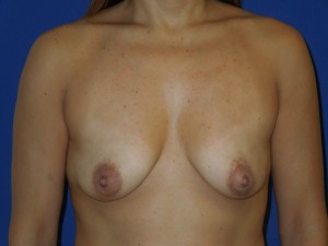 Before-Silicone Gel Breast Augmentation with upper arc (only) breast lift