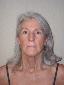 Before-yelids, Face and Neck Lift