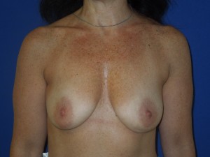 Before-A limited scar breast lift using the peri-areolar technique with implants. This patient was spared the common anchor scar breast lift.