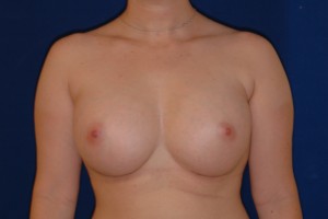 After-Breast Augmentation