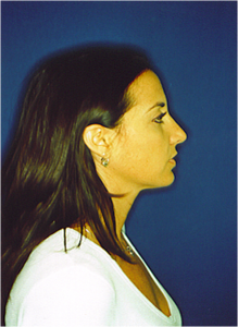 After-Nose Reshaping