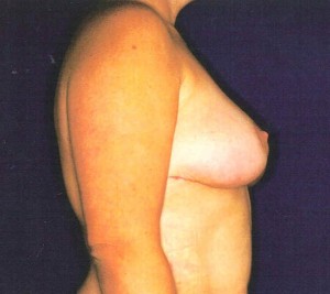 After-Breast Lift/Reduction