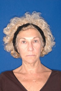Before-Eyelids, Face and Neck Lift