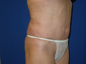 After-This patient had a poor result, with severe skin rippling, from traditional liposuction performed by another doctor. The after photo shows corrective secondary ultrasonic lipoplasty and mini-tummy tuck performed by Dr. Perez.