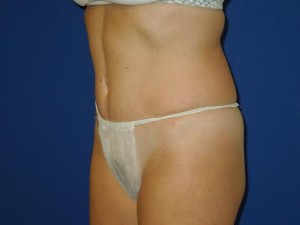 After-Tummy Tuck (Abdominoplasty)