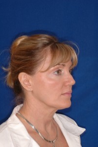 Before-Ultrasonic Necklift only
