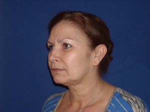 Before-Eyelids, Face and Neck Lift