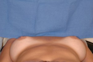 Before-Dr. Perez often corrects surgery performed by other surgeons. Here, a patient had breast augmentation by another surgeon resulting in a very wide gap in the chest. The patient referred to herself as \