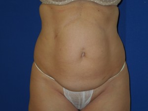Before-Abdominoplasty and flank ultrasonic lipoplasty