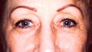 Before-Eyelid Tuck