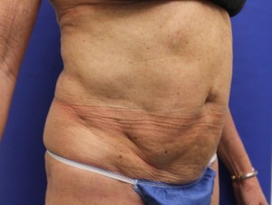 Before-This patient had a poor result, with severe skin rippling, from traditional liposuction performed by another doctor. The after photo shows corrective secondary ultrasonic lipoplasty and mini-tummy tuck performed by Dr. Perez.