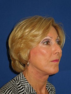 After-Lower Face and Neck Lift only