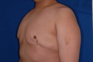 After-16 year old boy with severe gynecomastia