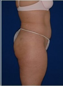 After-Tummy tuck and Ultrasonic Lipoplasty (UAL) of the flanks and back.