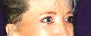 After-Upper and Lower Eyelids