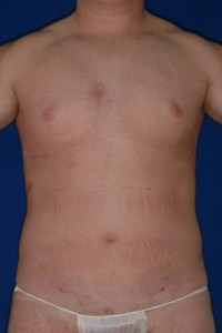 After-Ultrasonic Lipoplasty (UAL) of the male breast and abdomen. Before and One day after!