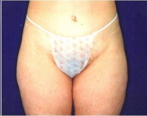 After-Extended Tummy Tuck