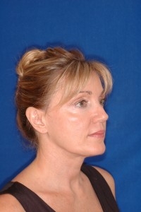 After-Ultrasonic Necklift only