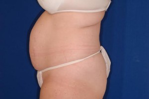 Before-Tummy Tuck (Abdominoplasty)