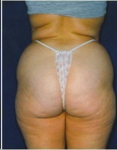 Before-Ultrasonic Lipoplasty of the flanks, back and thighs
