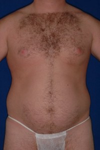 Before-Ultrasonic Lipoplasty (UAL) of the male breast and abdomen. Before and One day after!