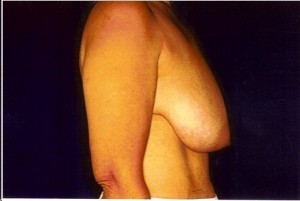 Before-Anchor Breast Lift