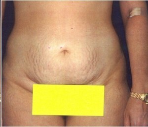Before-Extended Tummy Tuck