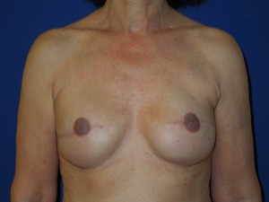 After-Breast Reconstruction following mastectomy for cancer