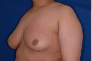 Before-16 year old boy with severe gynecomastia