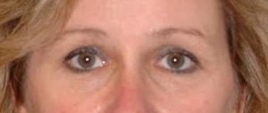 Before-Upper and Lower Eyelids