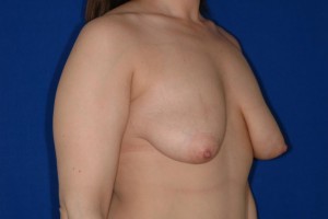 Before-The Anchor Breast Lift