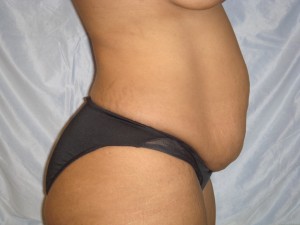 Before-Tummy Tuck