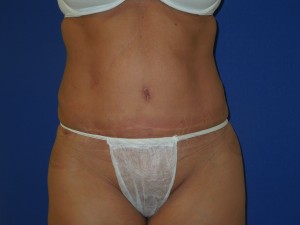 After-Abdominoplasty and flank ultrasonic lipoplasty