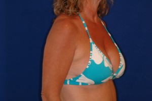 After-Breast Augmentation