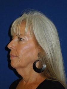 Before-Upper and Lower Eyelids, Face and Neck lift