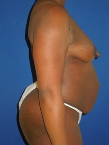 Before-Breast Implants with Limited Scar Breast Lift and Tummy Tuck