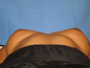 Before-This patient had breast augmentation performed by another board certified plastic surgeon. The before photo shows severe deformity and wide cleavage. The after photo shows corrective surgery performed by Dr. Perez. Remember, not all board certified plastic surgeons are the same. Our office sees many patients requesting corrective surgery.