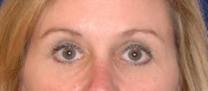 After-Upper and Lower Eyelids