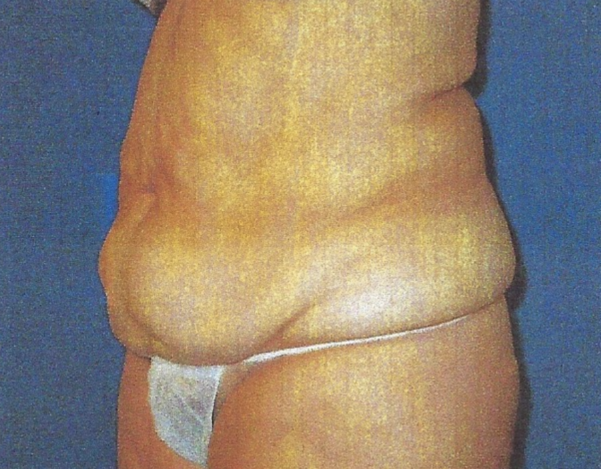 Before-Abdominoplasty