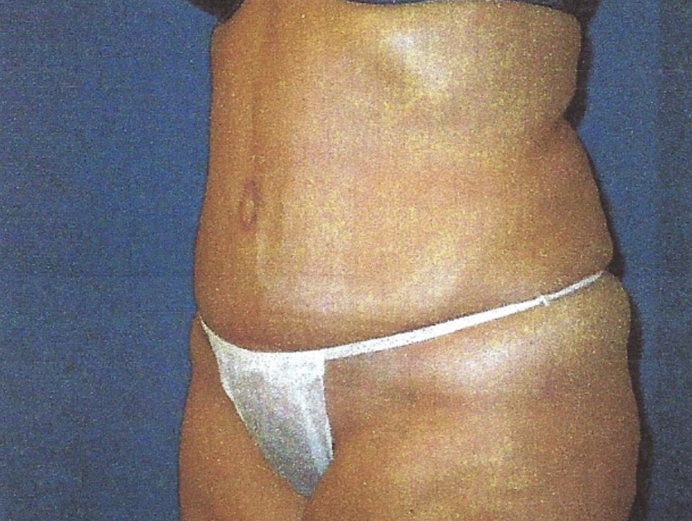 After-Abdominoplasty